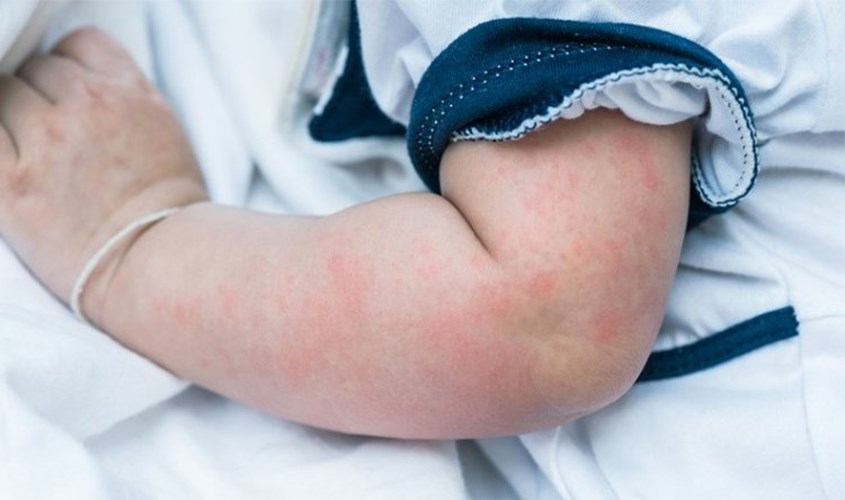 Các dấu hiệu khi trẻ bị dị ứng nước máy